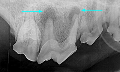 dental x-ray root abscess