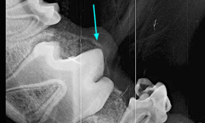 Dental x-ray delayed eruption