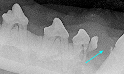 Dental xray showing impacted tooth and bone cyst