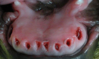 extraction lower incisors