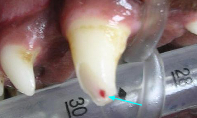 Fractured tooth pulp exposure