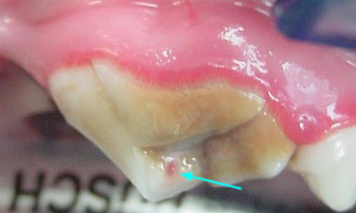 Fractured tooth exposing pulp