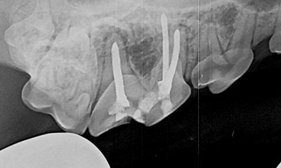 Root canal therapy fractured tooth dental x-ray