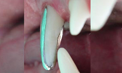 Partial crown for worn tooth