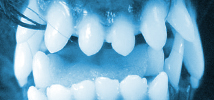 Persistent Deciduous Teeth