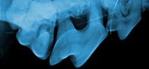 surgical extraction of teeth