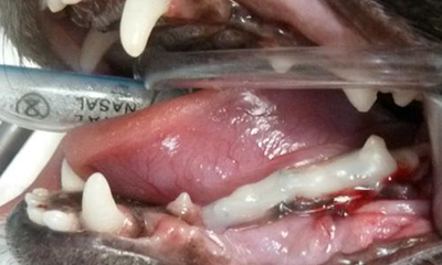 Interdental wire or composite splint repairing jaw fracture