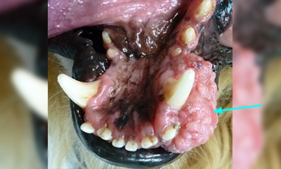 Oral tumor lower jaw.