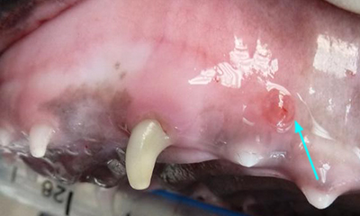 Tooth fracture abscess