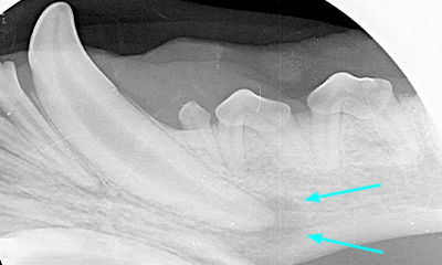 Infecção radicular por radiografia dentária